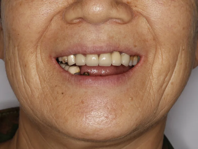 Dental restoration result used to illustrate treatment-plan comparisons