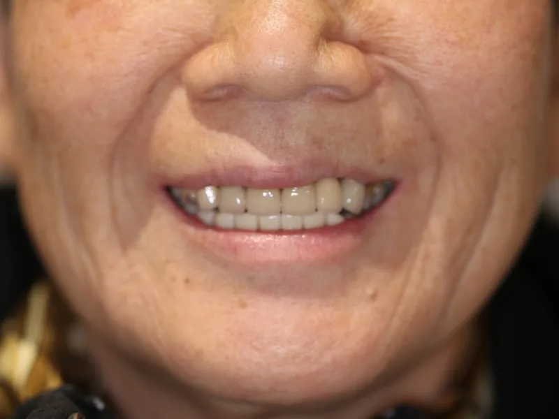 Dental restoration result used to illustrate long-term records