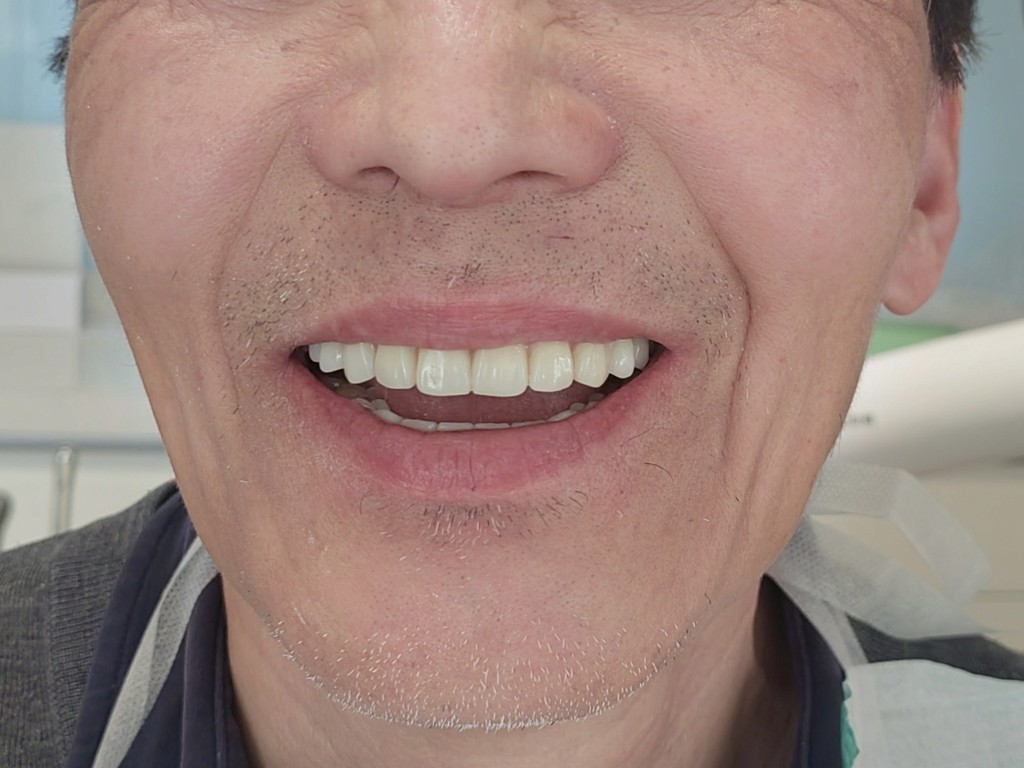 Dental Treatment Follow-Up After You Return Home