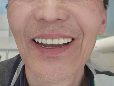 Dental Treatment Follow-Up After You Return Home