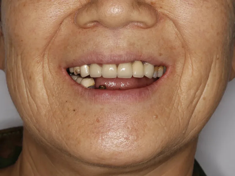 Full-arch dental condition before restorative treatment planning