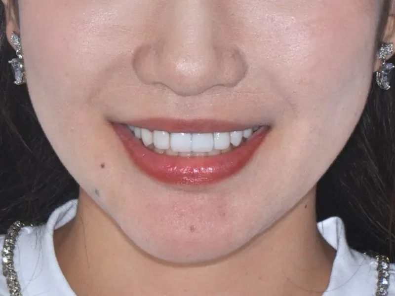 Restored smile used to illustrate follow-up planning