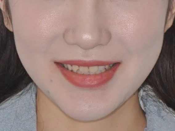 Smile before porcelain veneer planning