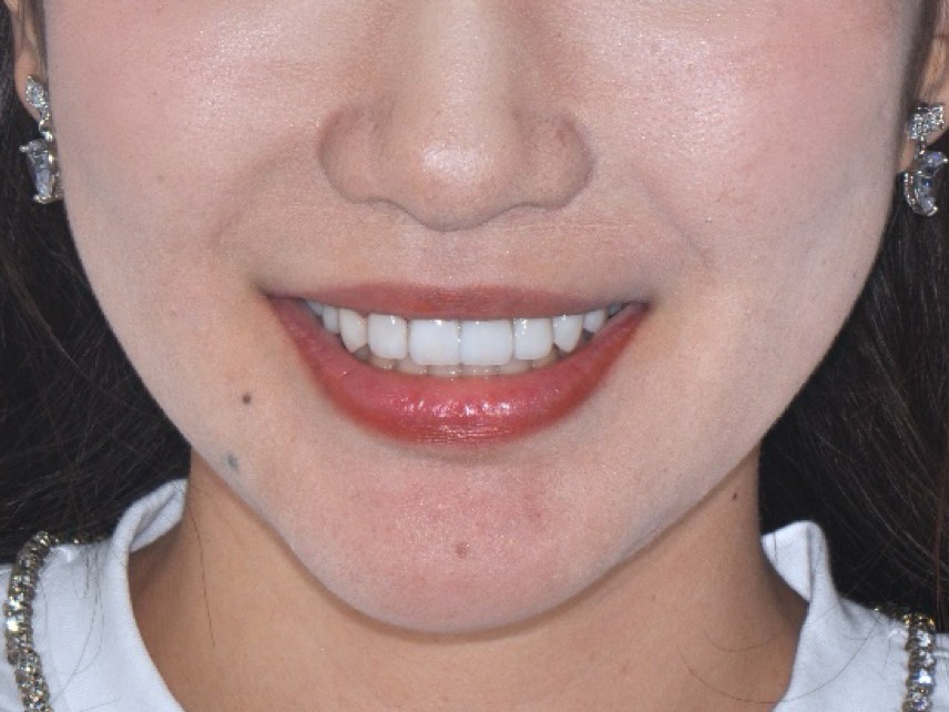 Porcelain Veneers in China: Trial Smiles, Materials and Timing