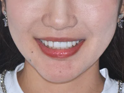 Porcelain Veneers in China: Trial Smiles, Materials and Timing
